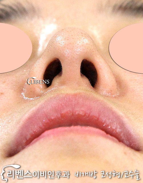 매부리코 메부리코 코끝 성형 수술 교정 무보형물 비염 성형 s634